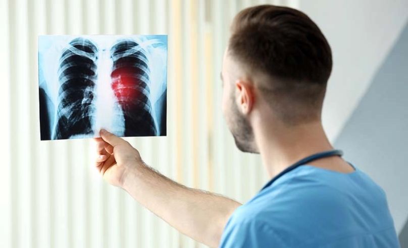 New Digital Platform to Aid Smokers in Early Lung Cancer Detection 