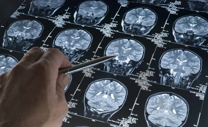 Abu Dhabi Hospital Unveils Brain Scan for Early Alzheimer’s Detection